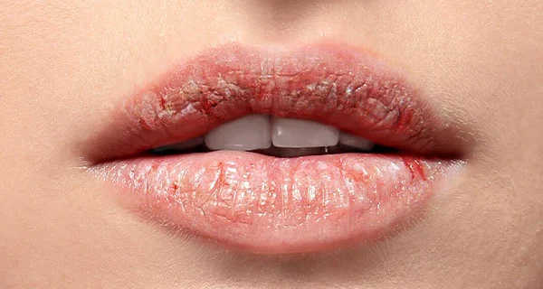 How To Get Rid Of Chapped Lips