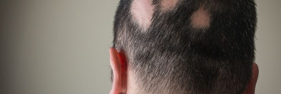 10 Home Remedies To Regrow Hair On Bald Patches
