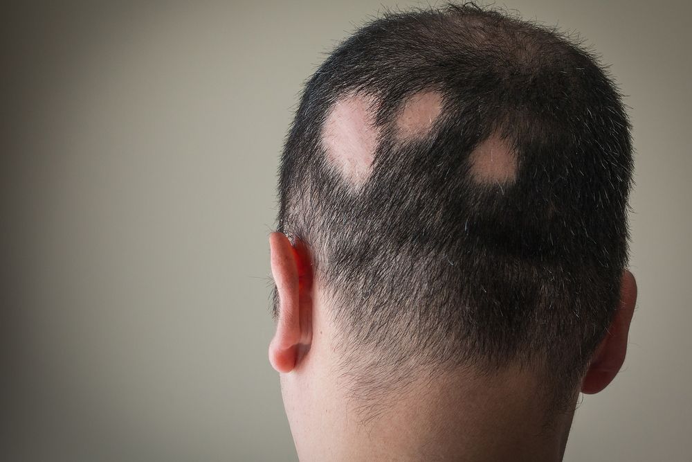 10 Home Remedies To Regrow Hair On Bald Patches