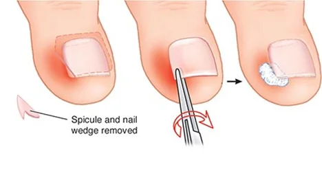 Treat Your Ingrown Toenail With These 6 Natural & Homemade Remedies