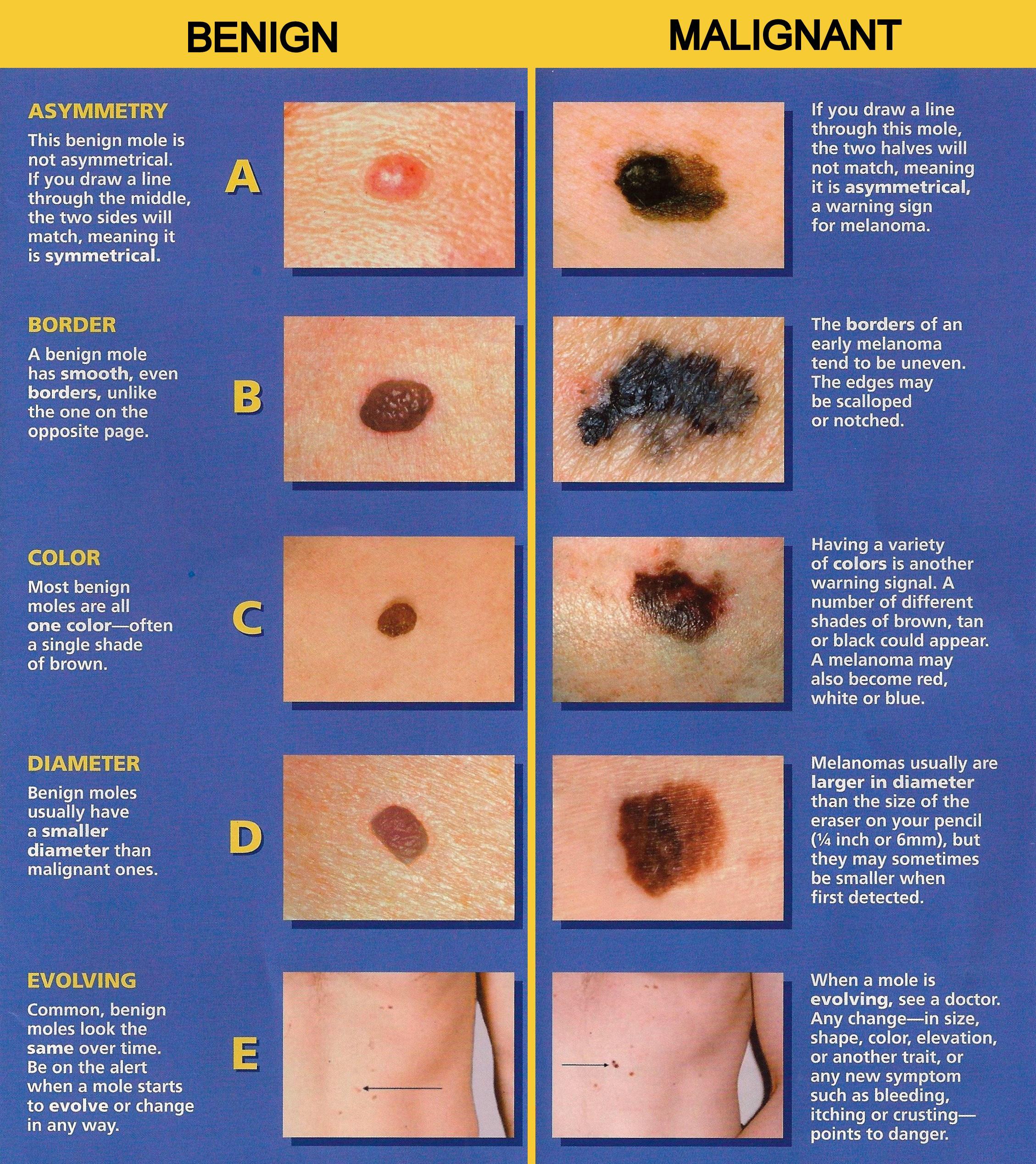 Different Types of Skin Moles