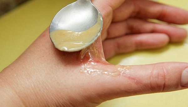 Heal-the-Scars-Burns-and-Stretch-With-These-Ingredients-That-You-Have-In-The-Kitchen