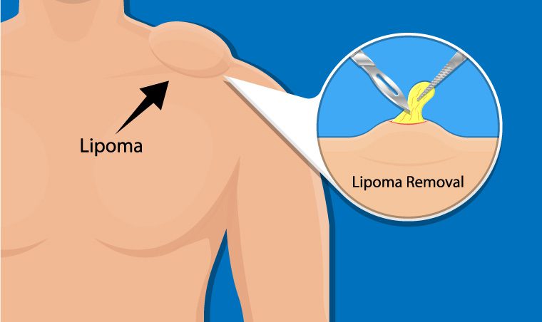 How to Treat Skin Lumps Known like Lipomas? Remove them naturally!